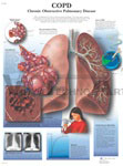 COPD - Anatomical Chart